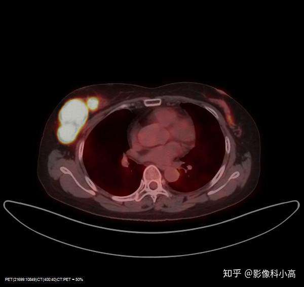 乳腺结节疑似淋巴瘤petct检查案例