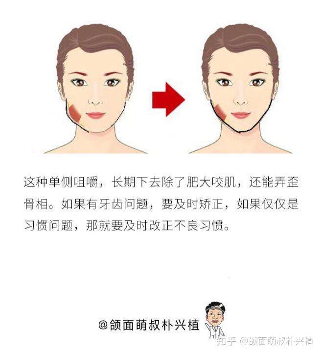 长期侧脸咀嚼导致左脸突起,右脸凹下,是不是应该用右侧咀嚼恢复脸型