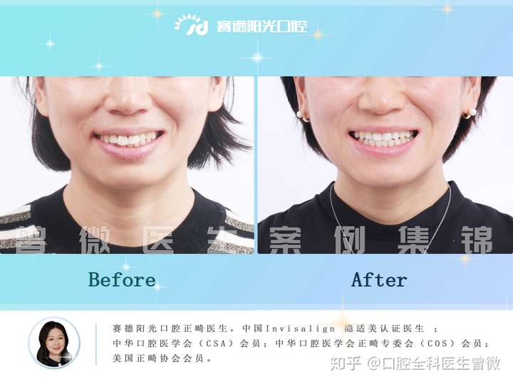 矫正牙齿必须要拔牙吗