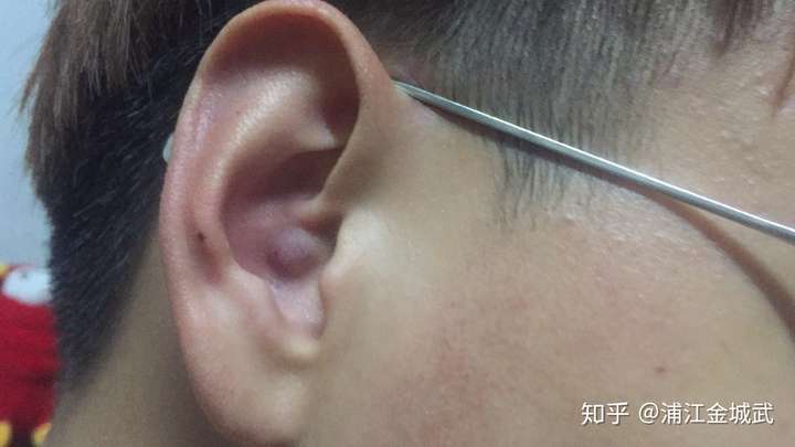 耳朵里长痘痘是一种什么体验?