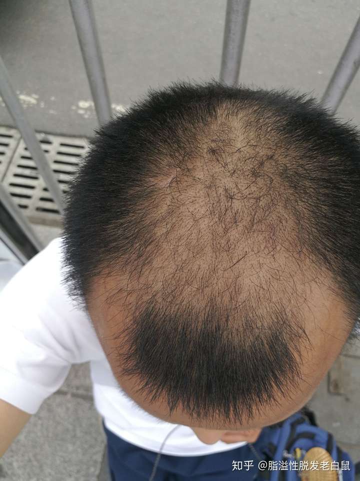 刮光头没用,去年就试过了,自己用电推推平后,拿剃须刀再弄一次,难看