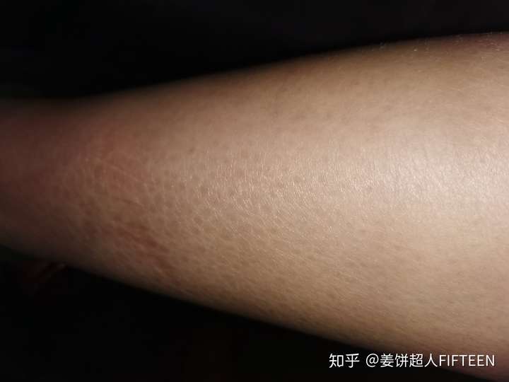 我现在的腿 红色是压痕
