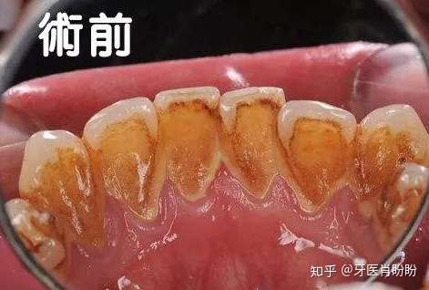 洗牙疼不疼,有人用手扣过牙结石吗?