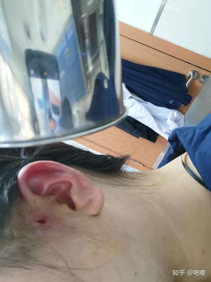 先上图     我还算幸运就一个耳仓,小时候人家有的都有俩,我就觉得