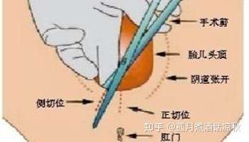 我有阴影是因为看的太多了,只要是初产妇,十个有九个都会被侧切一刀