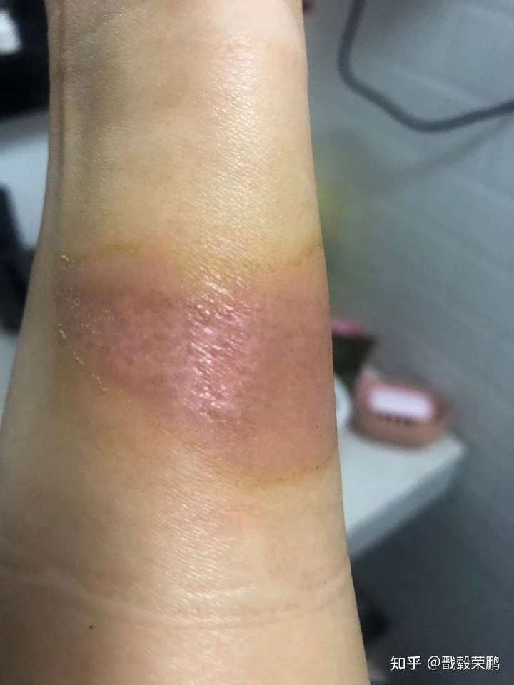 被烫伤后长出来的新皮肤是白色吗?