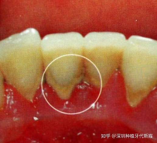 吸收,便会在牙龈上鼓起一个脓包,形成从根尖到牙根的瘘管,炎症产生的