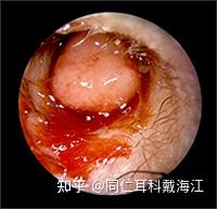 胆脂瘤胆脂瘤是长在耳朵里的肿瘤吗