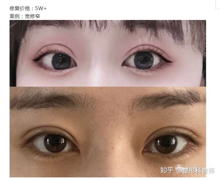4,不对称 5,提肌不当,眼睛闭不上 6,内眼角褶皱 7,多眼皮 一号案例:双