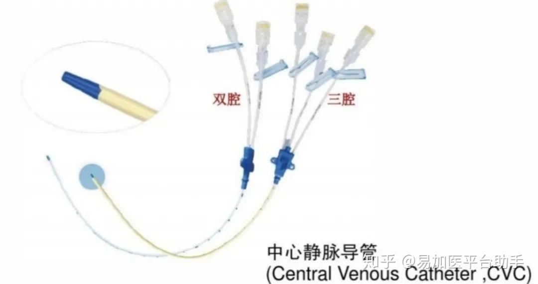 化疗置管选picc好还是cvc好?