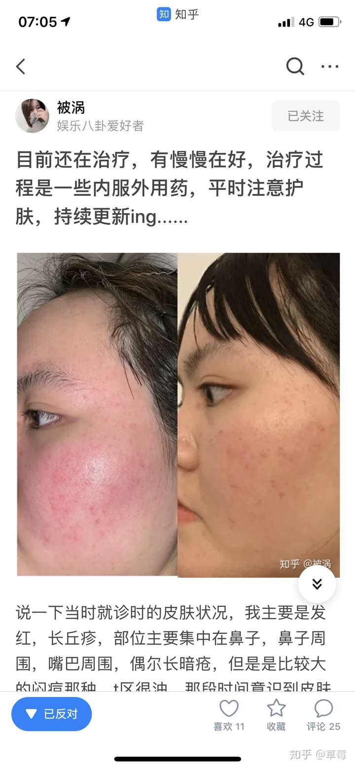 玫瑰痤疮的朋友都是怎么解决的