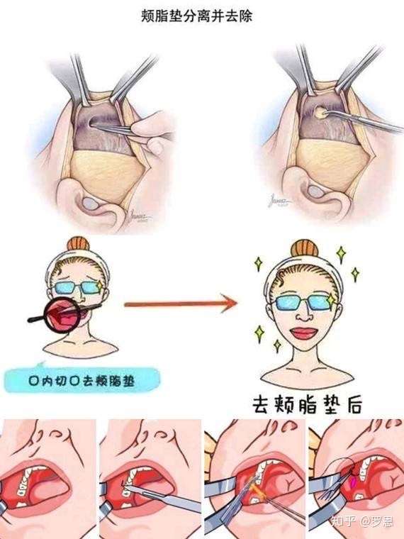 然后用力咬紧牙关根据局部的饱满程度来区分是皮下脂肪肥厚还是颊脂垫