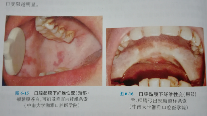 吃槟榔得了口腔黏膜纤维化怎么办?