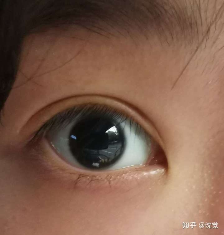 最近去医院查眼睛散了瞳 发现这才是真的黑 因为只有瞳孔是纯正的黑色