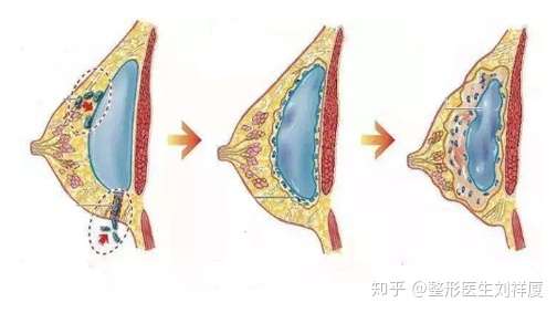 假体隆胸和自体脂肪隆胸相比哪个风险更小