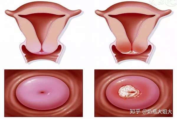 当宫颈外口的表皮的鳞状细胞被宫颈内口另外一种柱状上皮组织