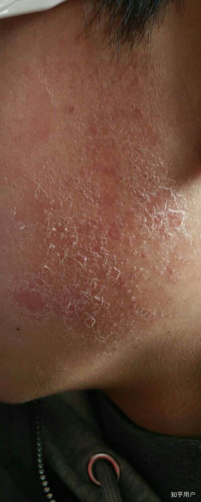 —— 皮肤过敏病情轻微时,可给予局部冷湿敷,再用单纯保剂.