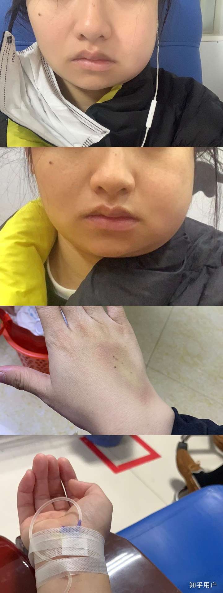 智齿发炎是一种什么体验?