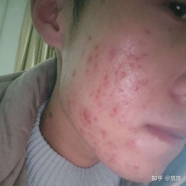 这是我男朋友之前脸上痘痘最严重的时候.