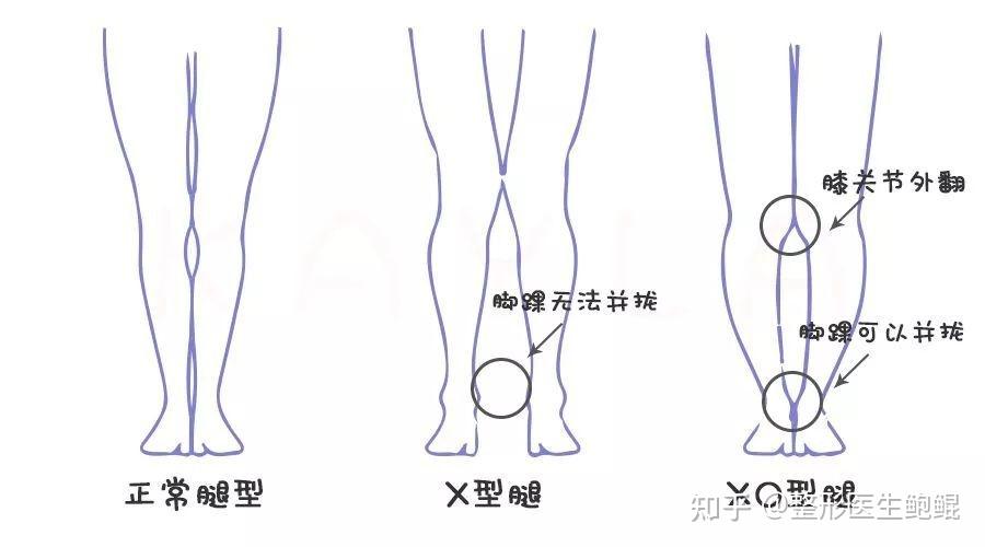 有没有什么改善x型腿的方法吗?
