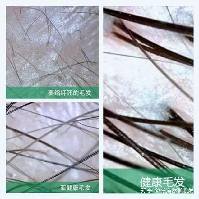 头顶头发有很多很短很细小的毛发一直长不长这些毛囊是萎缩了还是坏死