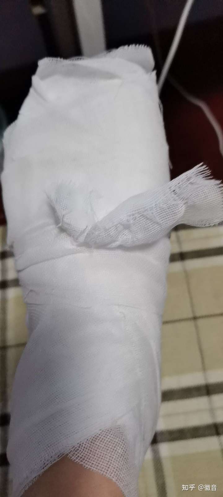 左脚第二跖骨骨折需要多久才能正常走路?