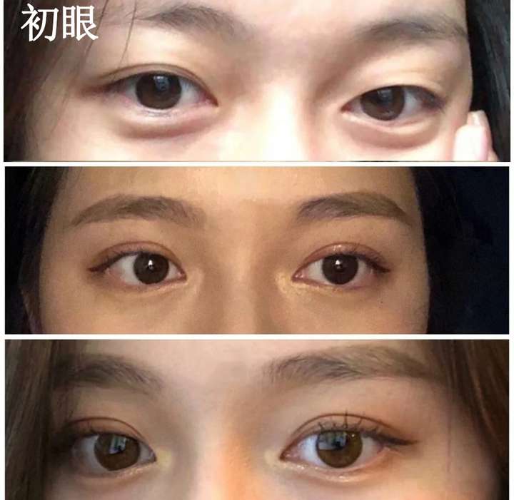 可以看出小姐姐也是有双眼皮的,但是眼皮松弛,上睑下垂,提肌无力