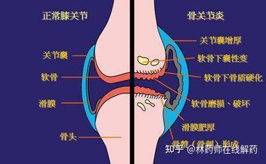 膝盖滑膜炎,有积液,可以吃迪巧吗?