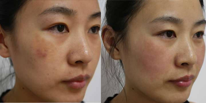 跪求黄褐斑治疗方法?