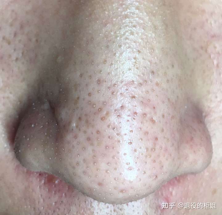 使用宝拉水杨酸几个月了,近一两个月几乎每晚都会使用,但黑头还是祛不