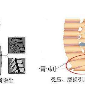 腰椎骨质增生