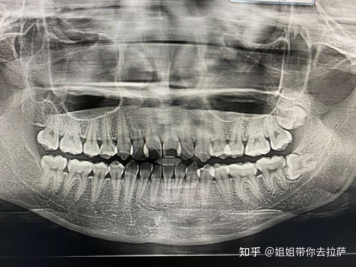 拔阻生齿要恢复很久么?