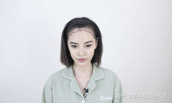 种植发际线安全吗,为什么几乎没见过女明星做这个项目的呢?