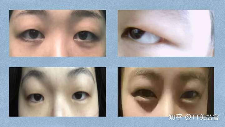 肿泡眼是什么?
