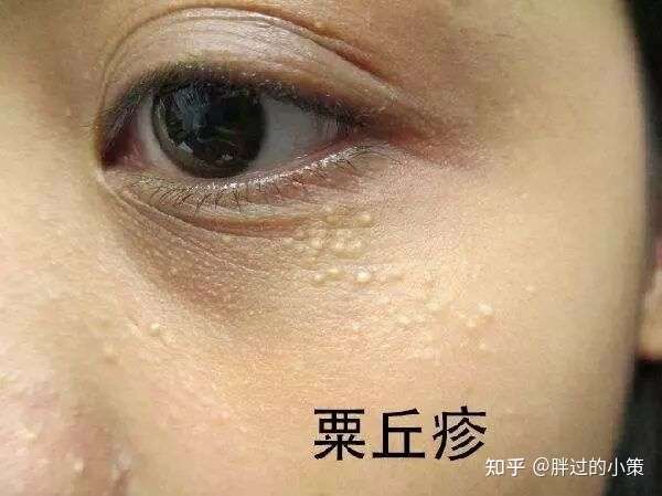 栗丘疹,俗称脂肪粒