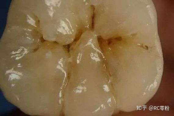 大牙发黑是为什么