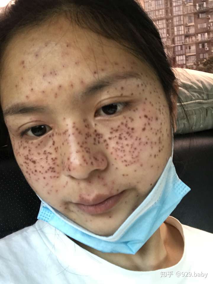 关于美容院的那种药水点痣点斑有人说有效有人说点了还不如以前谁真正