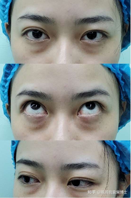 可以看看她的术前照: 遗传性眼袋,泪沟凹陷,还有黑眼圈!