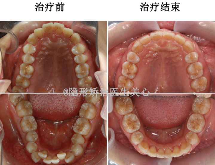 也是中国第一例隐适美拔牙矫正病例,改善嘴突,露龈笑,深覆合和牙弓