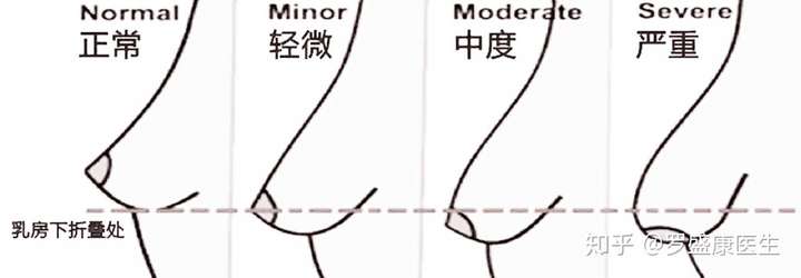 [乳房肥大缩小整形]人生的负重跑,大胸的难处有太多你