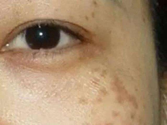 如何判别脸上斑的种类?