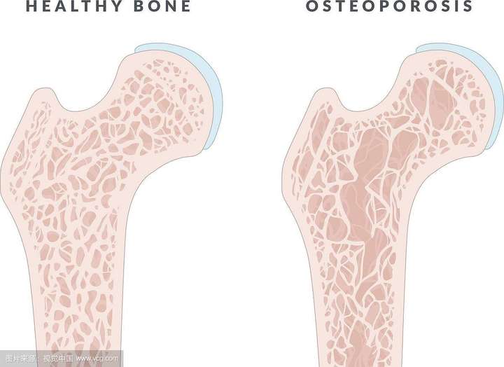 骨质疏松示意图:骨小梁密度的降低(图右)