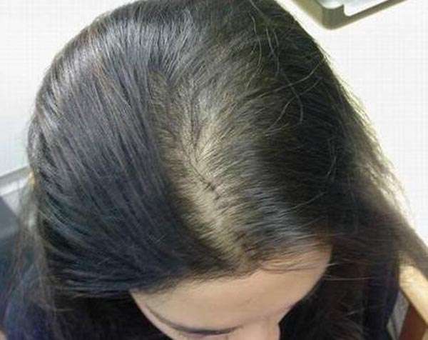 女生头发头顶特别少,有点脂溢性脱发,用什么洗发水可以改善?