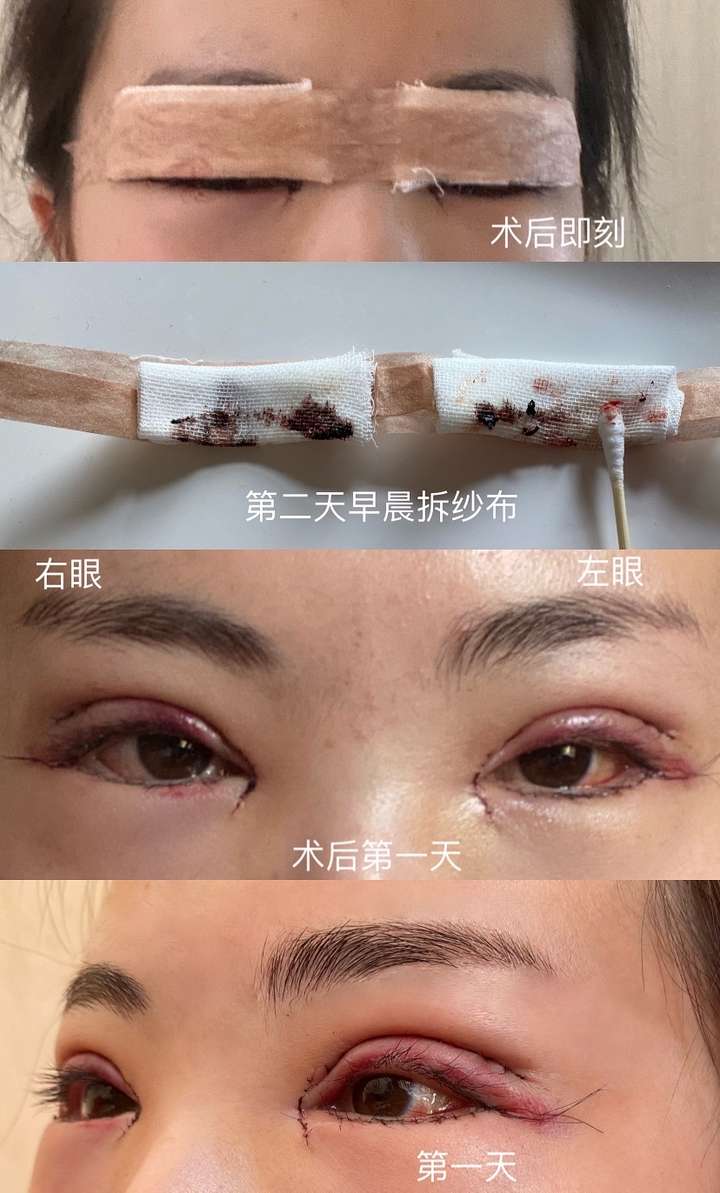 双眼皮手术 眼综合恢复过程?