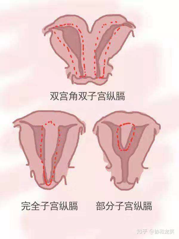 纵膈子宫可以生孩子吗?