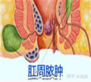 肛周脓肿是怎么引起的