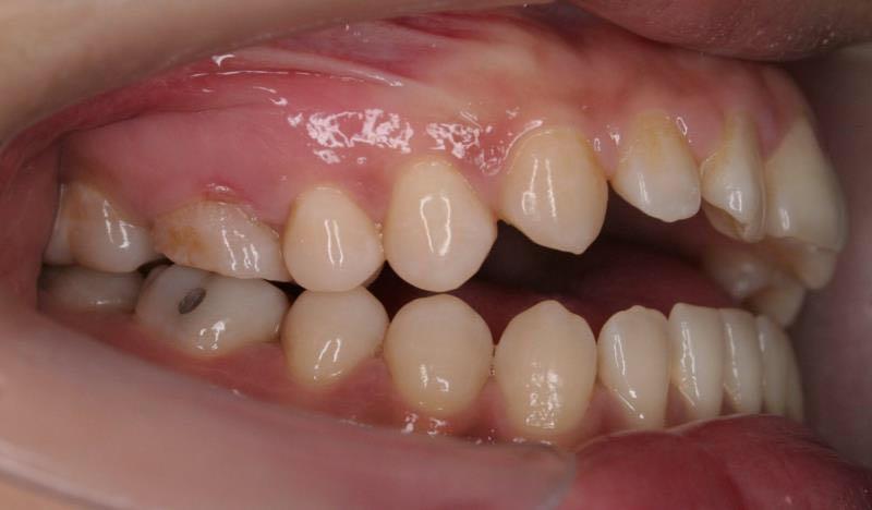 牙齿骨性开颌可以带牙套解决吗?