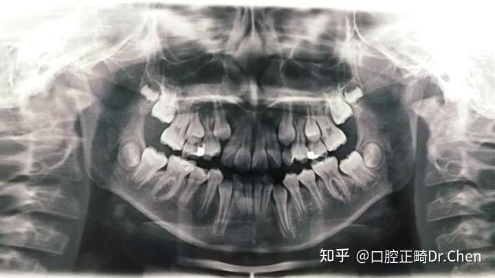 口腔全景片
