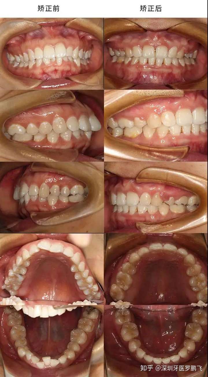 这种情况需要牙齿排齐需要拔牙或者扩弓,或者两者都有,牙弓窄,牙床不