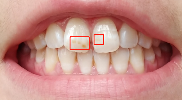 牙齿上的黄斑如何清除?